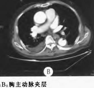 如何监测动脉夹层早期,动脉增强ct能查出主动脉夹层么