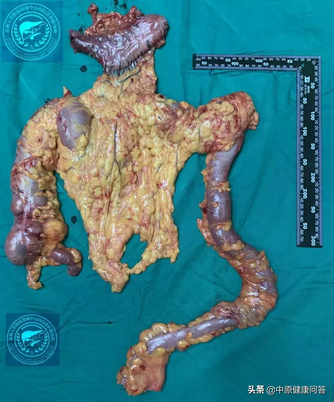 56岁子宫内膜癌,62岁女子宫内膜癌患癌