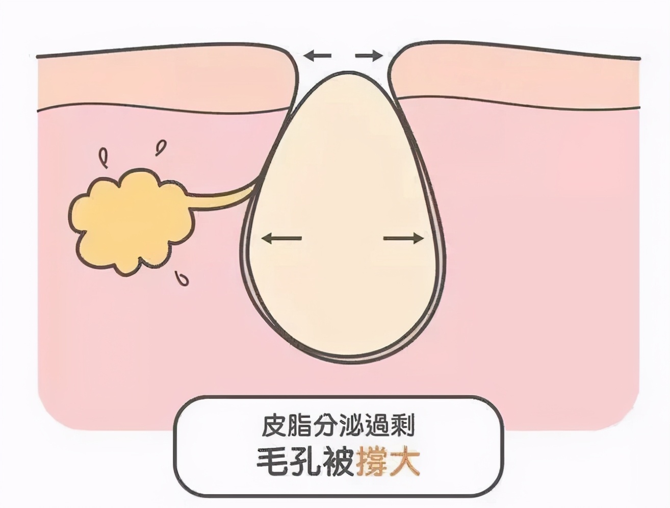 黑头粉刺毛孔粗大怎么隐形毛孔,毛孔粗大cc霜怎么用才能隐形毛孔