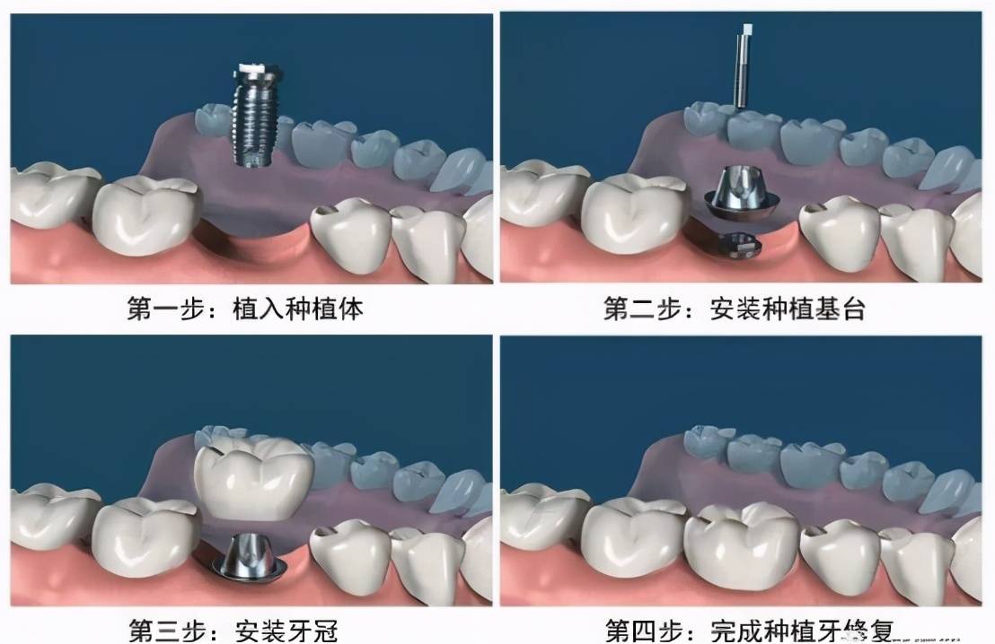 雅悦齿科能恢复牙齿吗,种植牙去医院好还是去康美齿科好