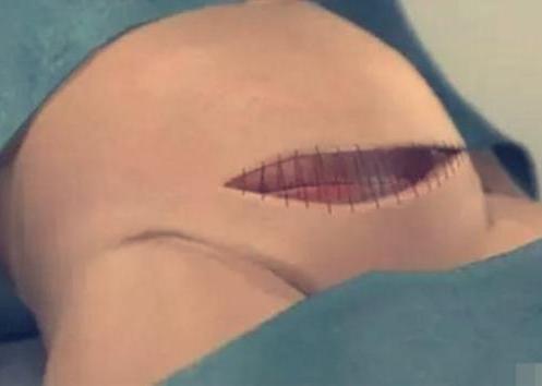 7张图揭露产妇“剖腹产”全过程，男人都该看，网友：母爱太伟大