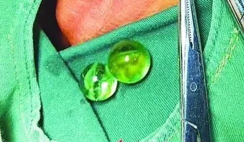 小孩子塞进异物怎么办,幼儿园女童被塞异物