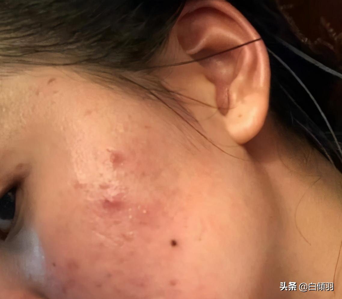 青春期满脸痘痘怎么治,脸上长痘痘心里自卑怎么办