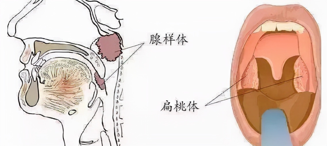 省中医看腺样体肥大哪个医生最好,儿童腺样体重度肥大的危害