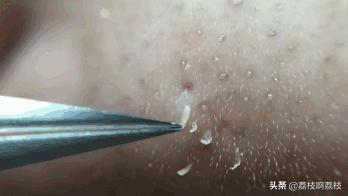 挤完黑头一个洞洞怎么处理解压,挤完黑头留下的洞洞怎么办