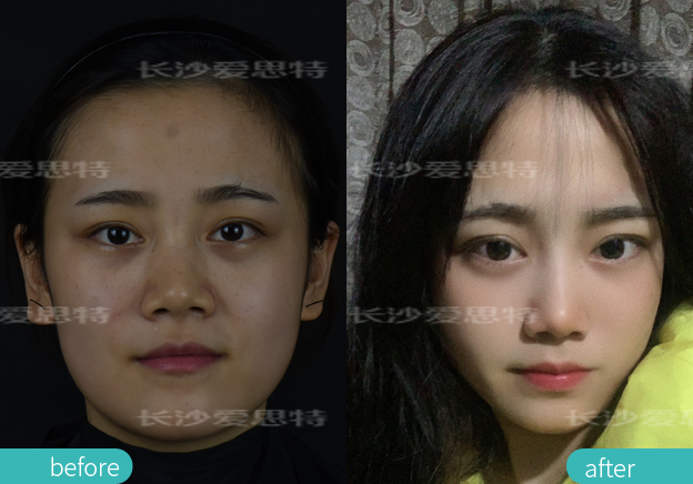 雀斑适合光子嫩肤还是皮秒,祛雀斑用超皮秒好还是光子嫩肤好