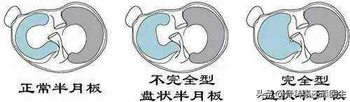 膝盖半月板撕裂会有后遗症吗,膝盖弯曲时嘎吱响是半月板损伤吗