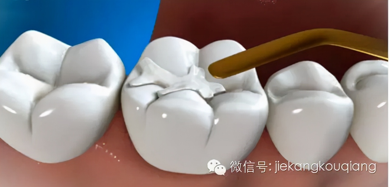 牙医一般都用什么材料补牙洞,牙医补牙全过程