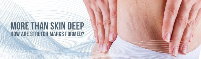 怎么预防妊娠纹的发生,妊娠纹越长越多赶紧试试这个方法