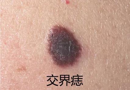 痣能点吗,我的痣凸起来会癌变吗