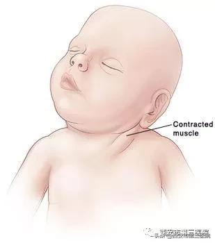 宝宝平常歪头容易导致斜颈吗,宝宝歪头症和斜颈可以治愈吗