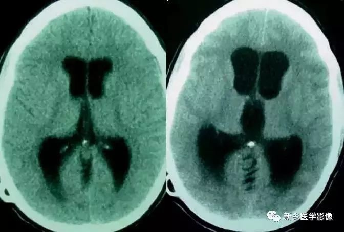 脑室影像学表现,脑室占位影像