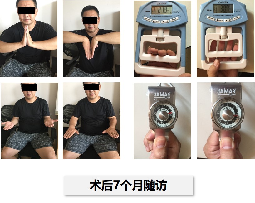 摇晃手臂肩关节有咔咔响,晃动手腕咯咯响正常吗