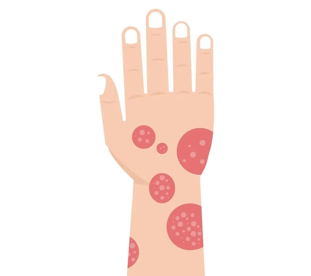 手上起了几个红疙瘩还痒是脚气吗,手上有像脚气之类的泡发痒怎么办