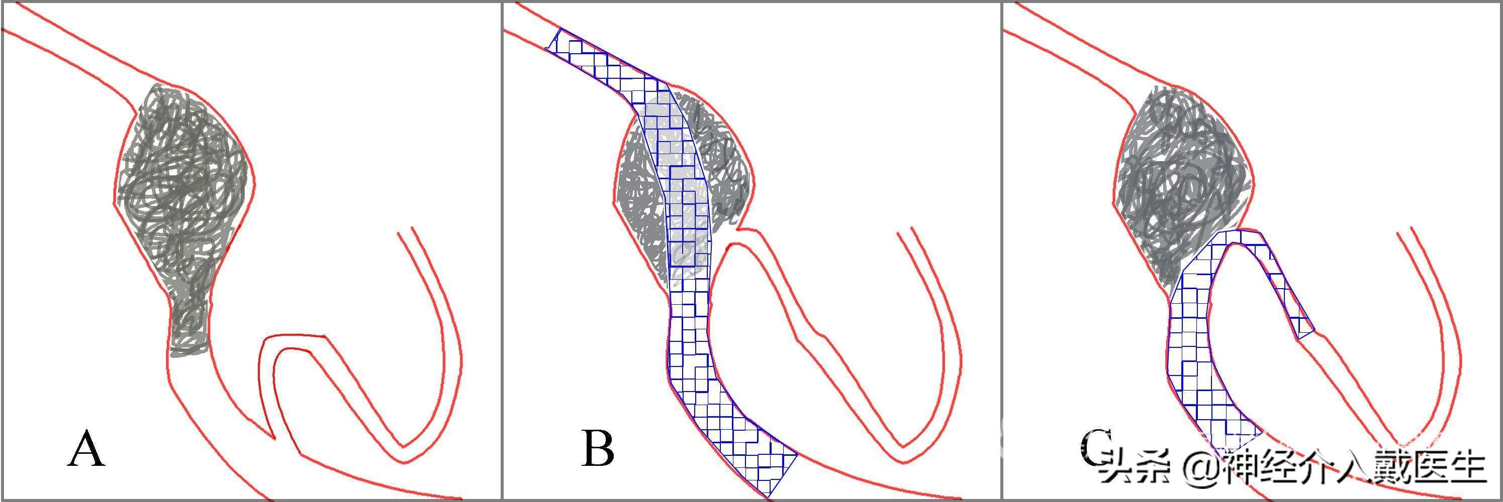 神经外科手术动脉瘤,湖南省人民医院脑动脉瘤介入治疗