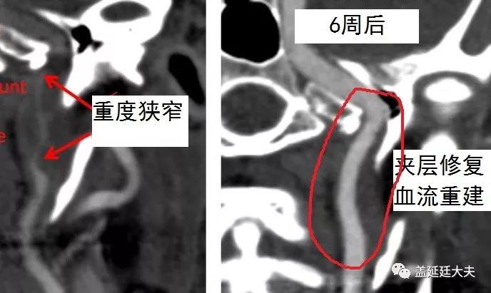 DR盖延廷||颈动脉夹层该如何治疗