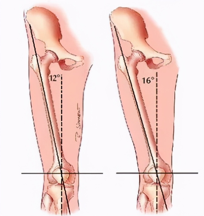 错误跑步姿势造成的危害,正确的跑步姿势远离跑步膝