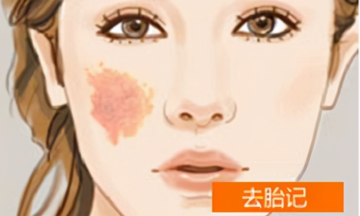 多发咖啡斑去除最佳年龄,咖啡斑激光能彻底去除吗