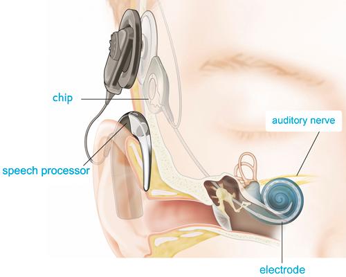 听神经瘤可能一辈子不发作吗,听神经瘤是什么病