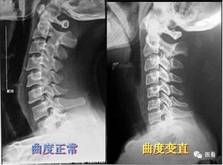 颈椎生理曲度变直矫正方法,颈椎曲度变直如何矫正最有效方法