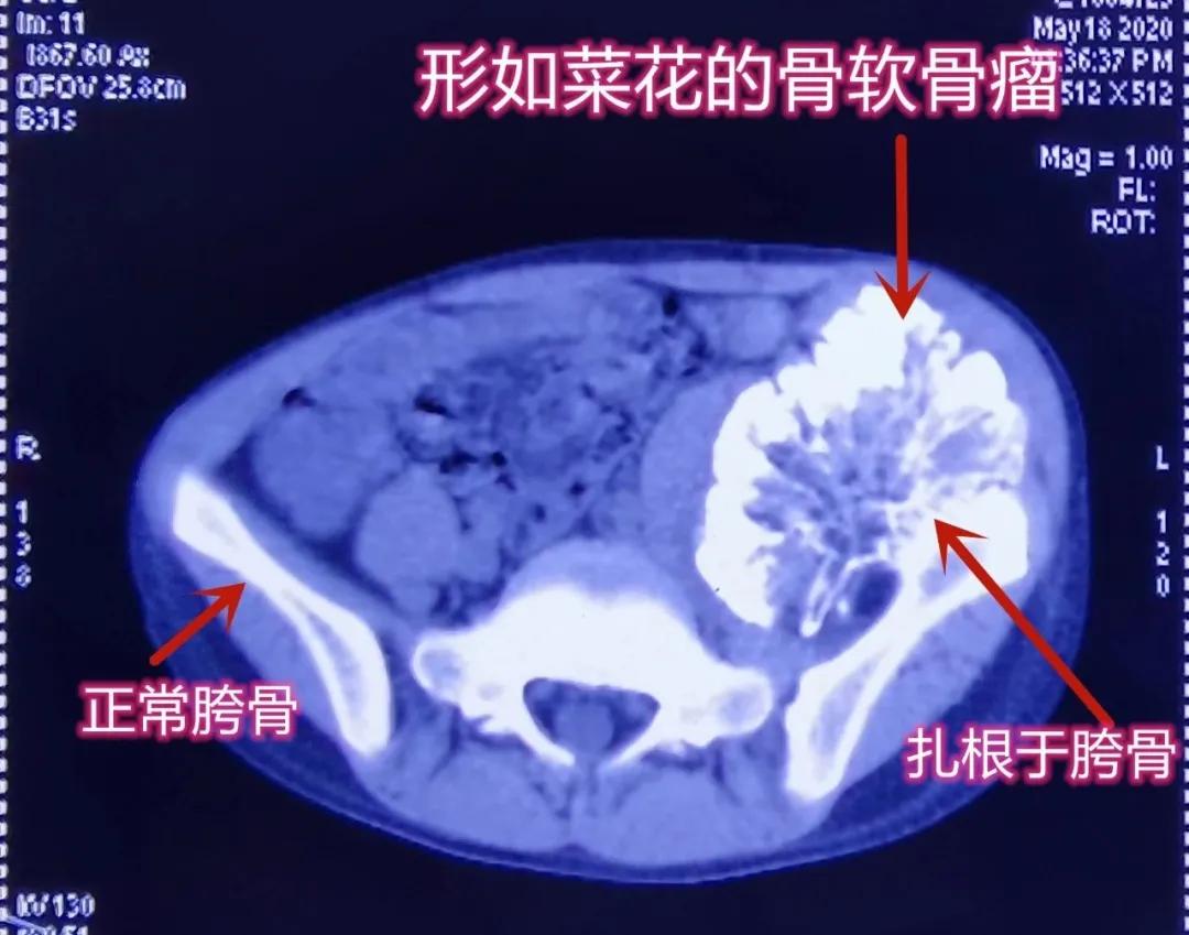 孩子胯骨处长了一个硬疙瘩,小孩胯部肉里长疙瘩怎么回事