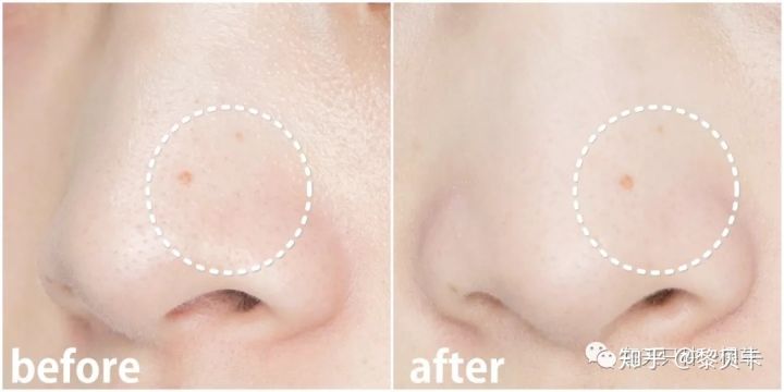 公认最好用的去黑头神器,网红推荐去黑头神器