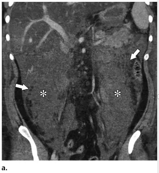 急性胰腺炎影像检查首选,急性坏死胰腺炎影像