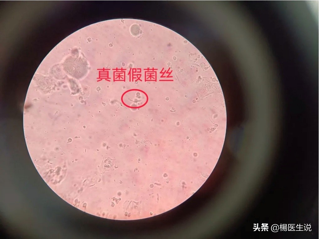 真实病例：滴虫合并霉菌性阴道炎，实属少见