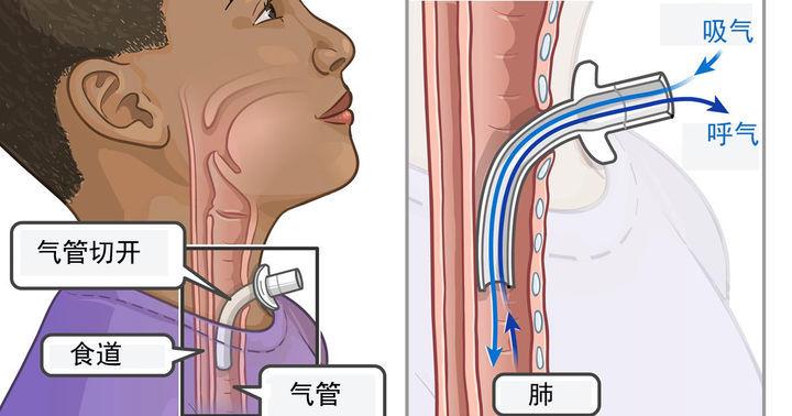 呼吸机止鼾选单水平还是双水平,止鼾呼吸机的正确使用方法