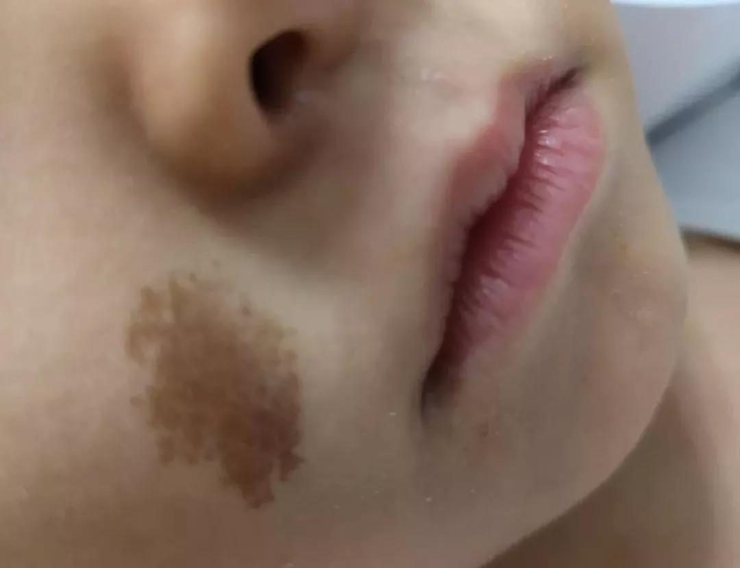 斑需要如何治疗,斑多如何调理