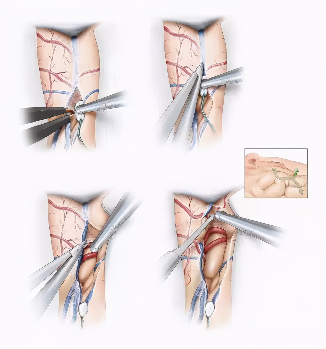 岛叶胶质瘤手术是开颅还是微创,岛叶良性胶质瘤复发率