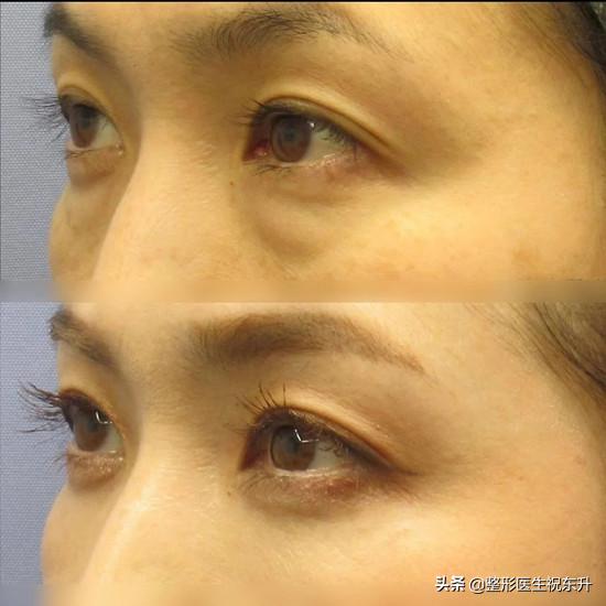 做眼袋手术的说说,关于眼袋手术的一些知识