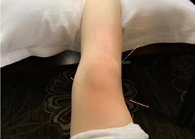 膝盖因积水而痛怎么治疗好得快,膝盖为何积水