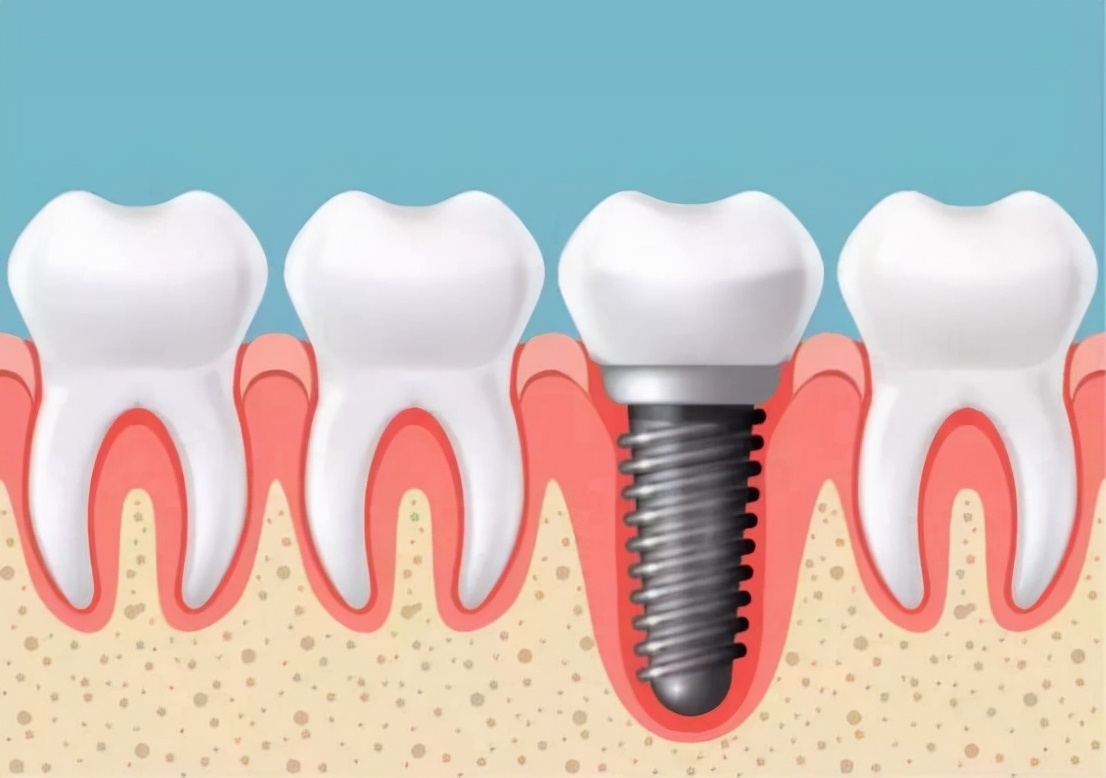 种植牙成为牙齿修复的最佳选择,种植牙是牙齿修复的最佳选择吗