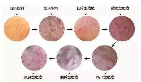 为了祛痘，小伙买10条活蚂蟥放脸上！结果悲剧了……