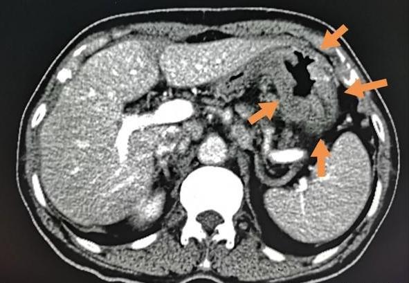肚子咕噜咕噜响胀气是怎么回事,肚子咕噜胃胀气