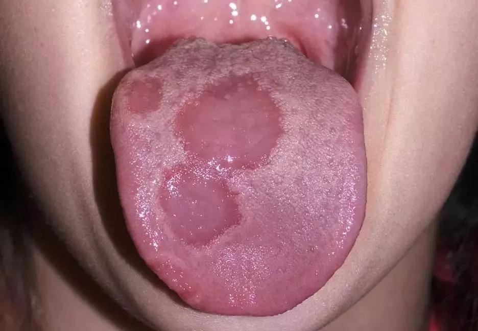 宝宝舌头地图舌是怎么回事,宝宝舌头辨别疾病图片