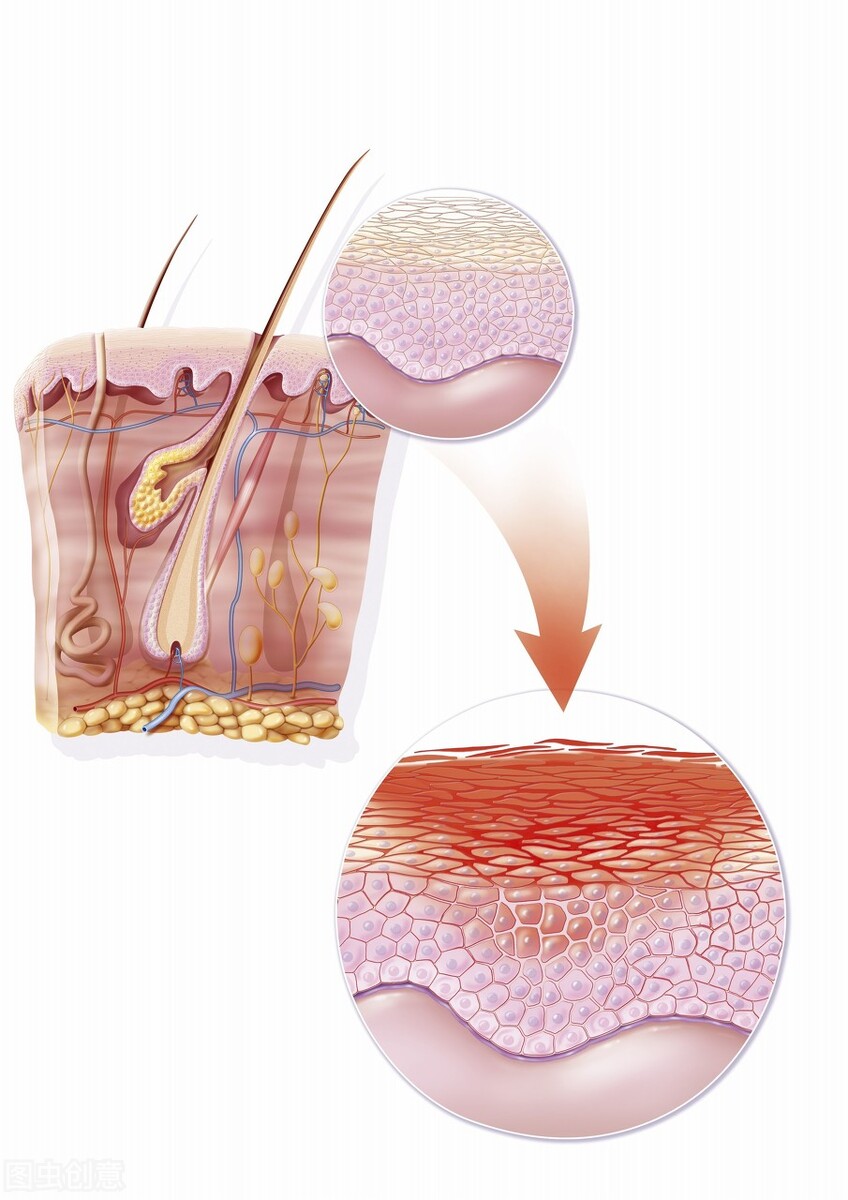 湿疹是真菌性皮肤病吗,婴儿湿疹真菌感染的症状