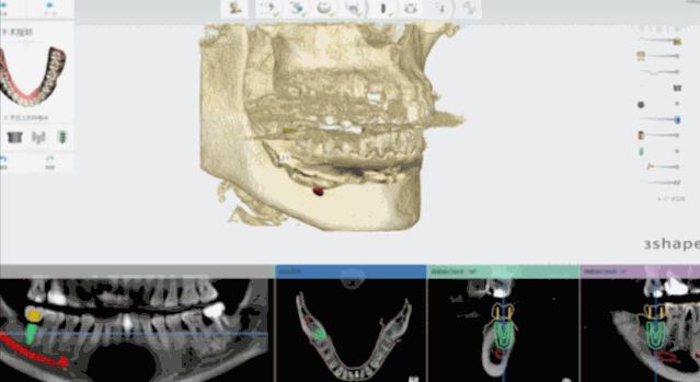 日照口腔医院种牙价目表,日照口腔医院种植牙价目表