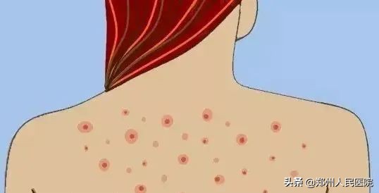 孩子身上长了水猴子怎么治,小孩身上总是长水瘊子