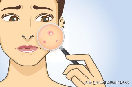 额头脸颊下巴长痘怎么调理,额头脸颊下巴反复长痘如何调理