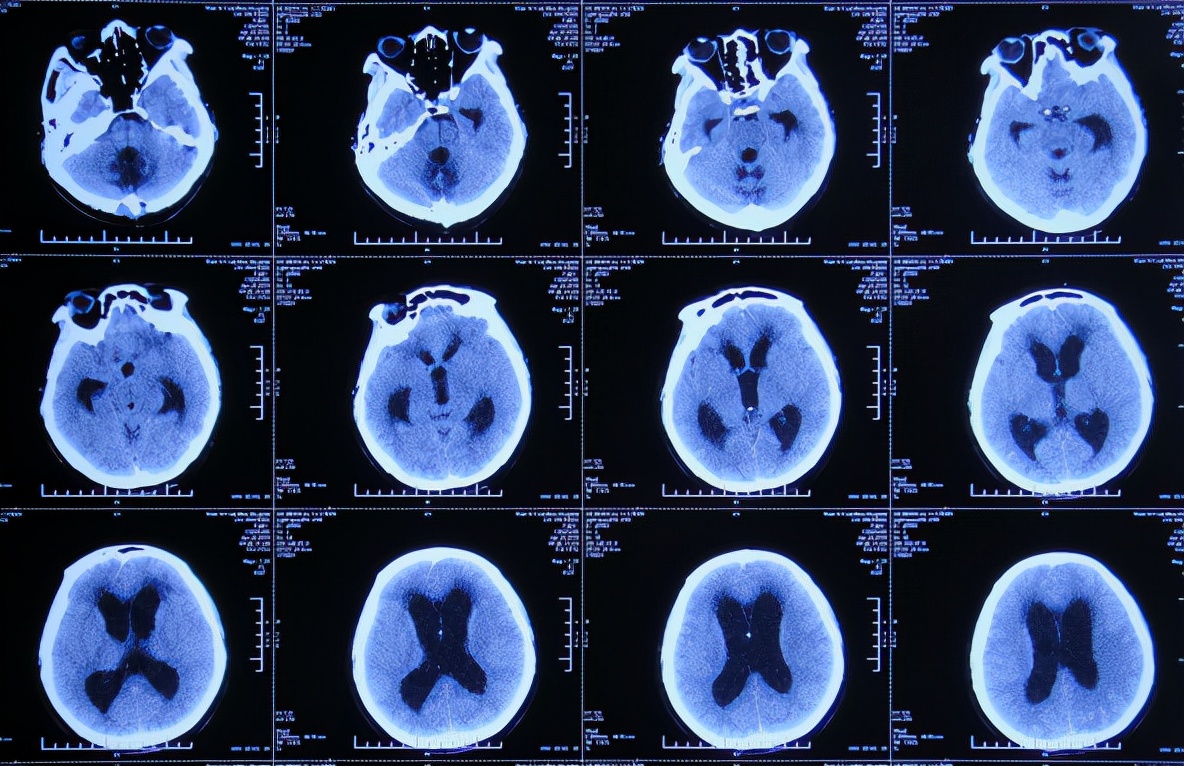 脑出血后脑积水会造成意识不清吗,脑出血后脑积水发高烧危险期多久