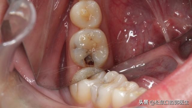 补牙齿补上的会掉吗,补的牙齿老是掉