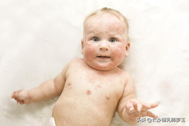 40天宝宝身上起小红点,宝宝身上起小红点用什么药膏