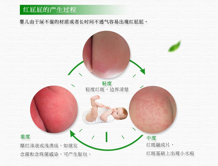 宝宝屁股淹了怎么护理,宝宝淹屁股怎么处理