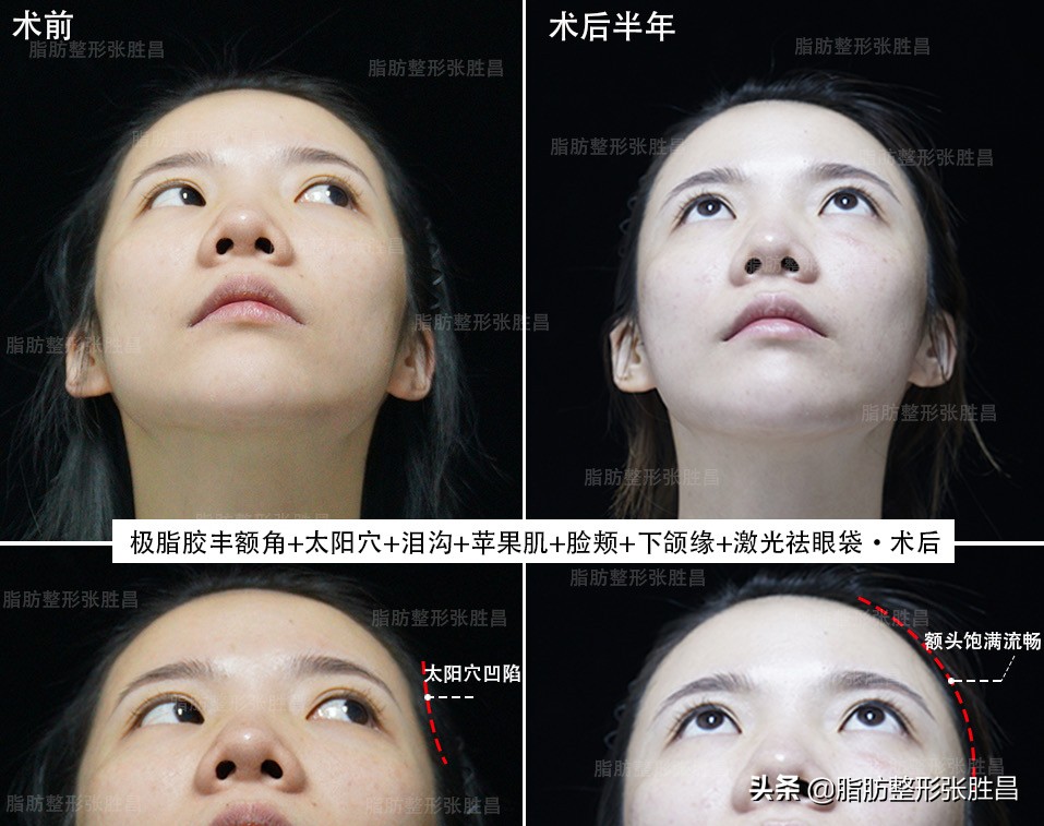 为什么脂肪填充要全麻,为什么脂肪填充算是整容