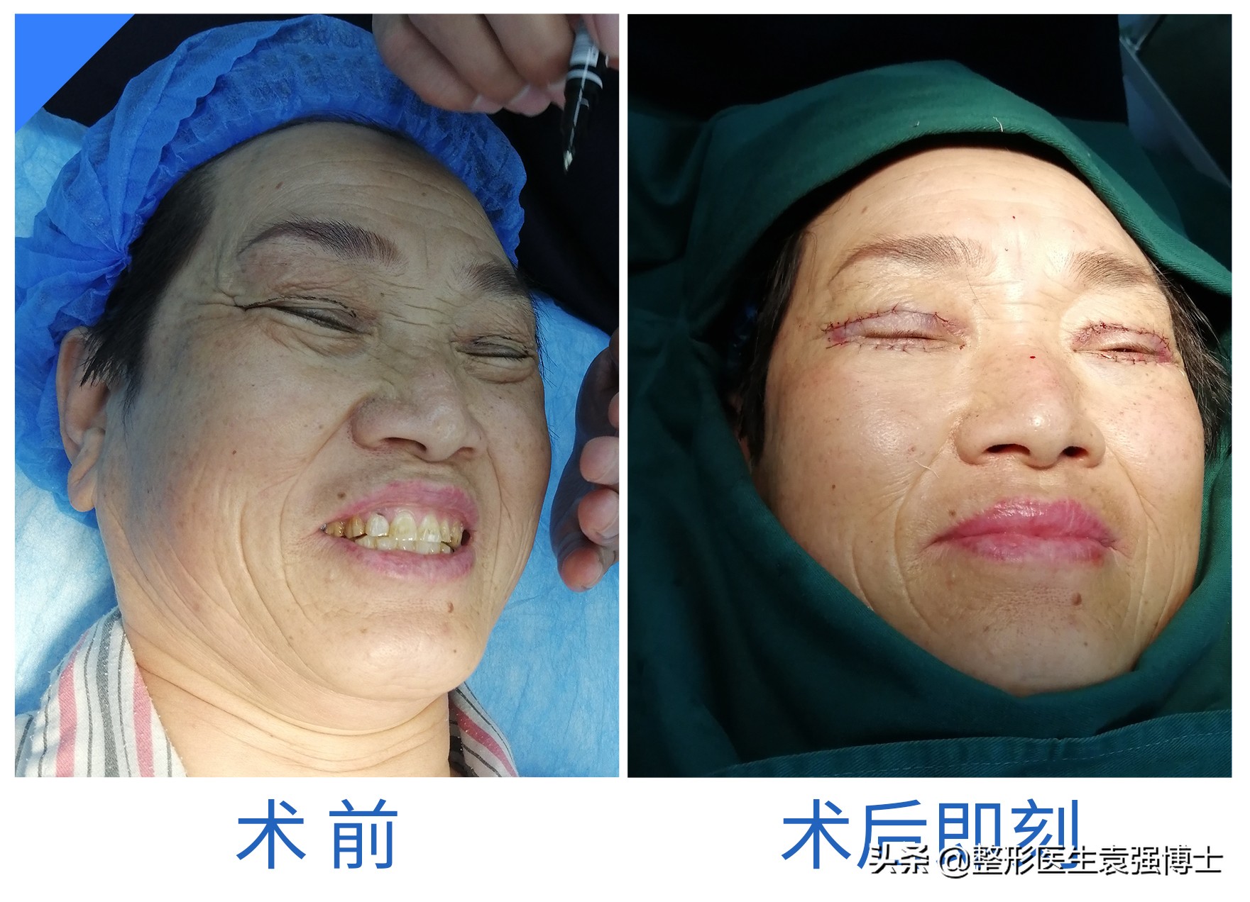 双眼皮提眉一起做半年效果,双眼皮提眉一起做几天能热敷