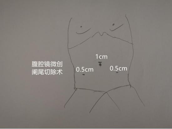 热血外科|Dr.Liu聊科普:阑尾炎究竟是何方妖孽？