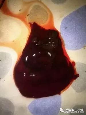 自己药流大出血,自己药流差点死亡