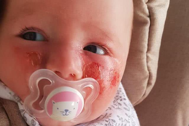 毒花致面部烧伤,女学生被毒花感染